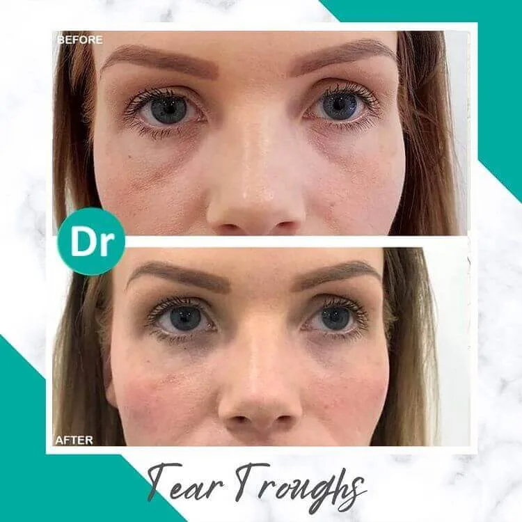 Under Eye Fillers Gone Wrong Not