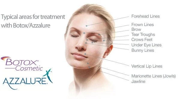 botox areas