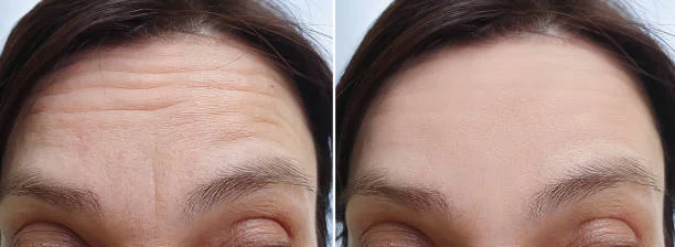 getting botox