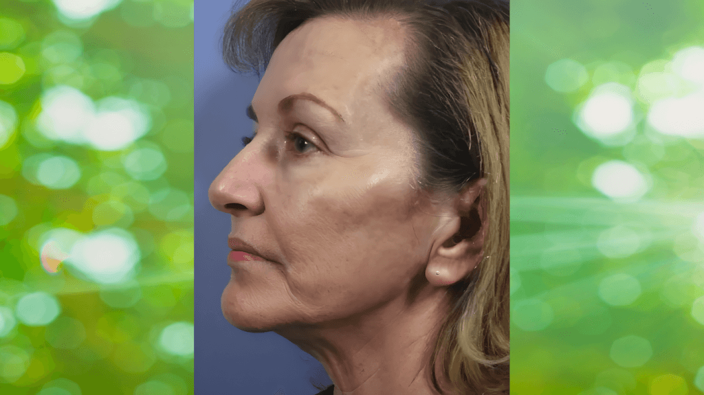 50 years old 8 point face lift cost