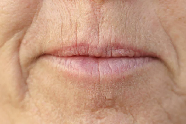 Reduce Nasolabial Folds & Purse String Wrinkles #smile lines #laugh lines  #lips wrinkles #shorts - YouTube