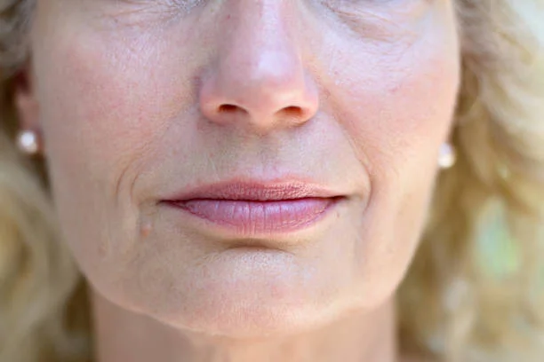 How Do You Treat Fine Upper Lip Lines? – West Institute | Chevy Chase  Dermatology - Dermatologist | Bethesda, Maryland
