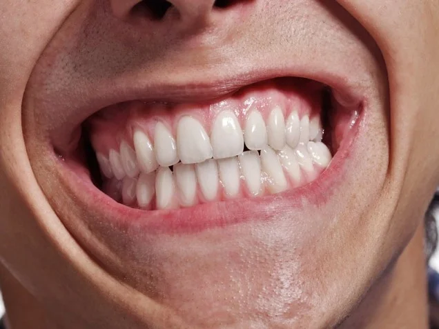 Image of a man grinding his teeth