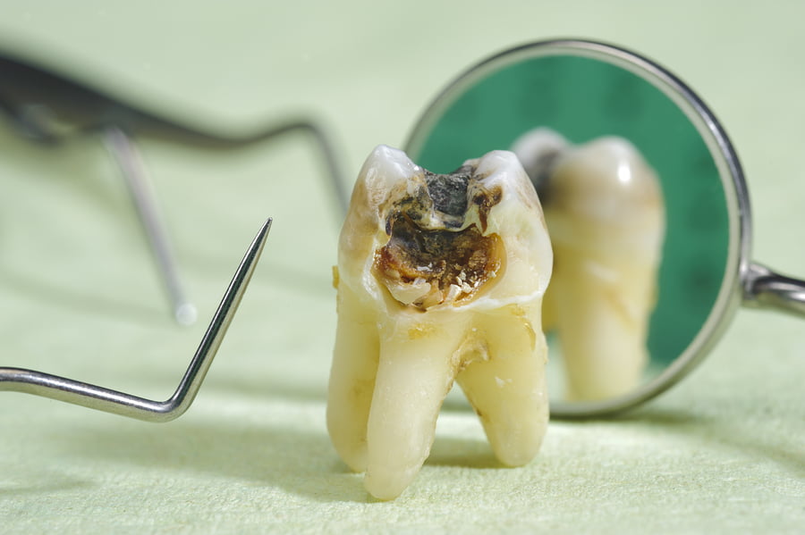 Image of an extracted tooth with cavities and dental equipment