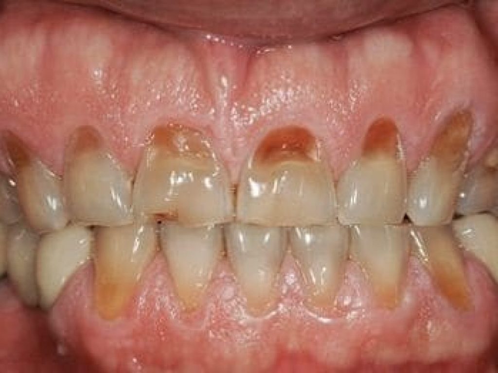 cavities formed from teeth grinding