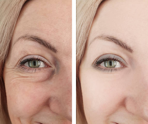 woman eye wrinkles before and after procedures