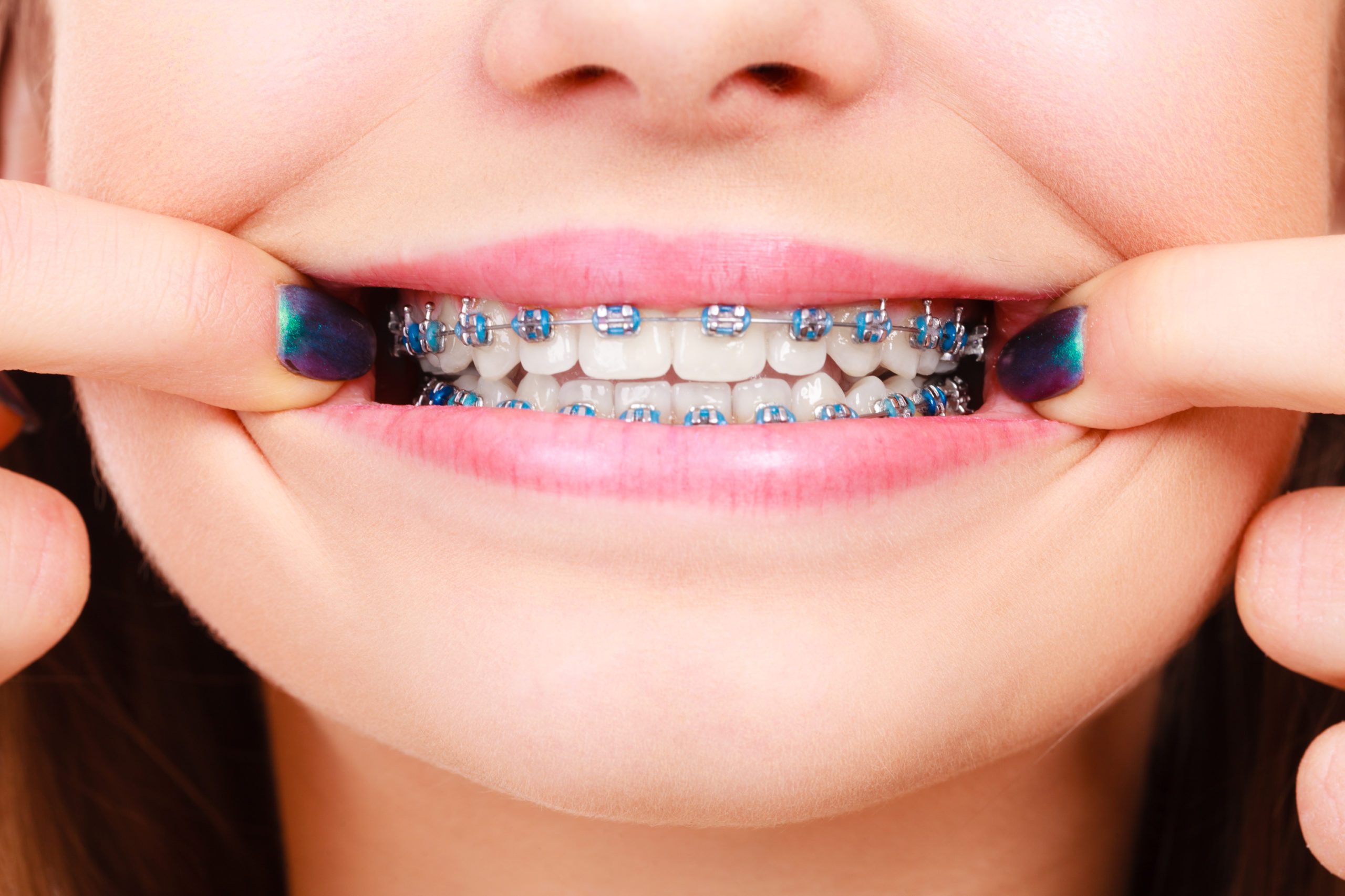 A Helpful Encyclopaedia on Grinding Teeth with Braces