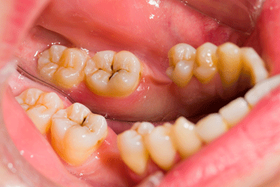 Image of a person opening their mouth revealing the cavities on their teeth.