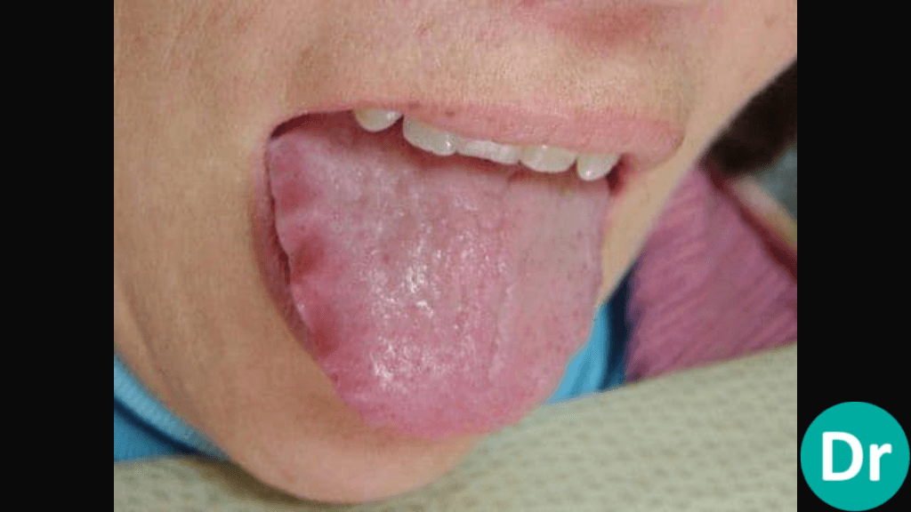 Scalloped tongue