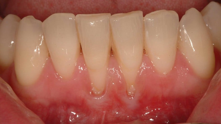 an image of gum recession