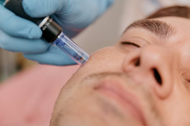 Microneedling patient