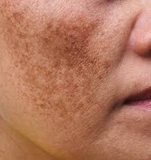 Pigmentation on a persons face