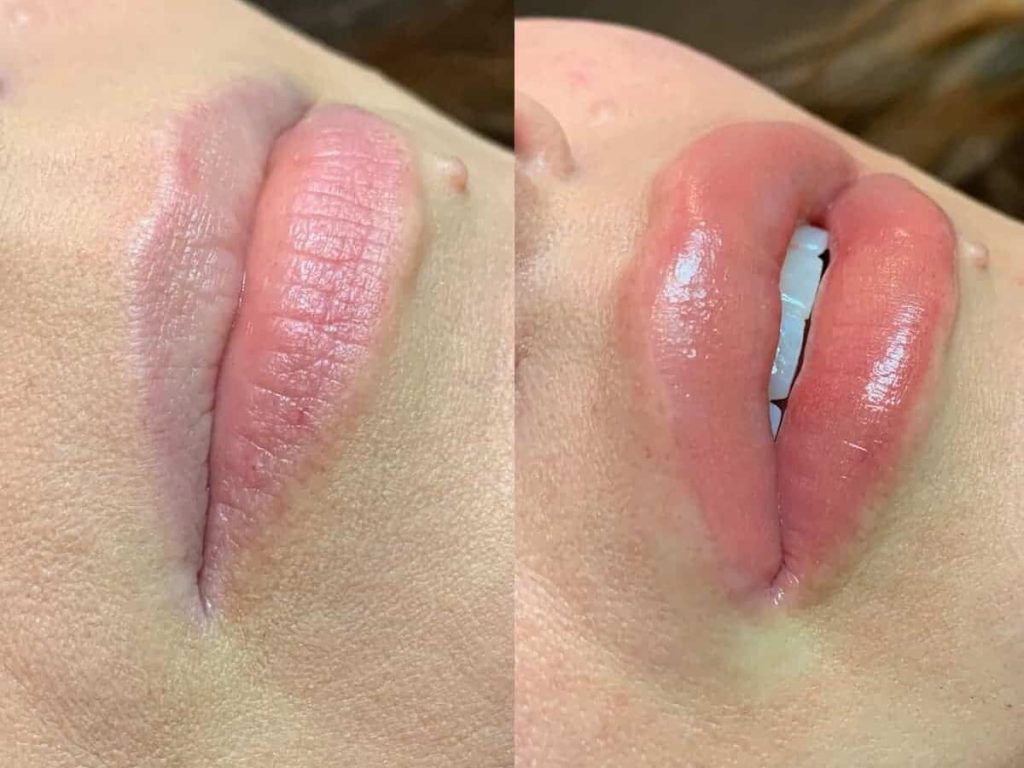 Lip filler results before and after