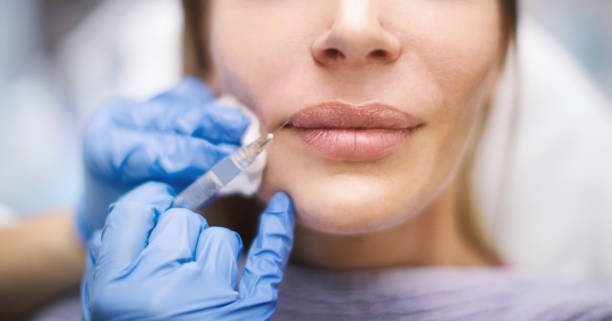 Lip flip treatment