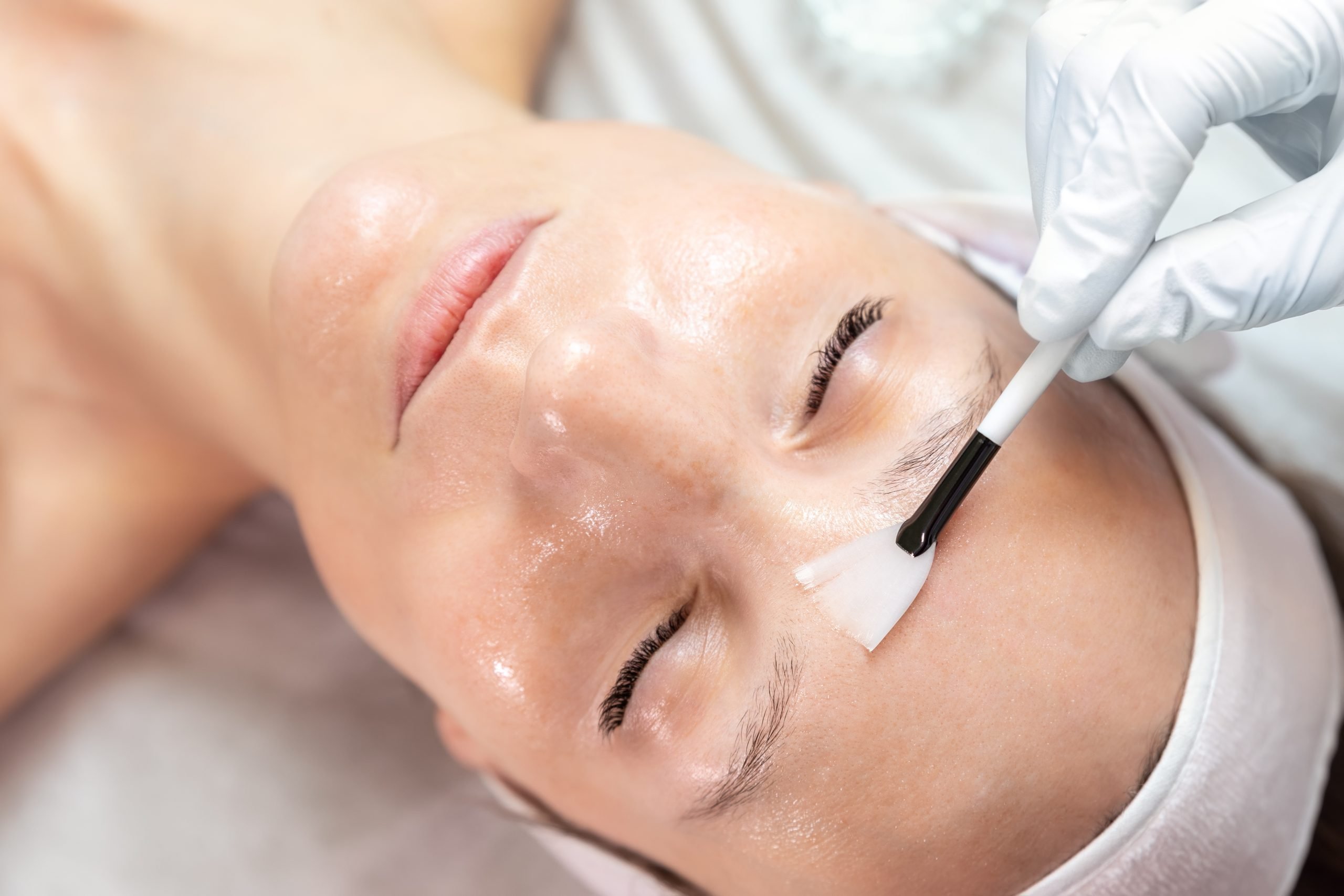 Mastering the Art of Chemical Peels for Radiant Skin