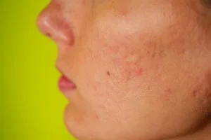 acne scars from popping pimples