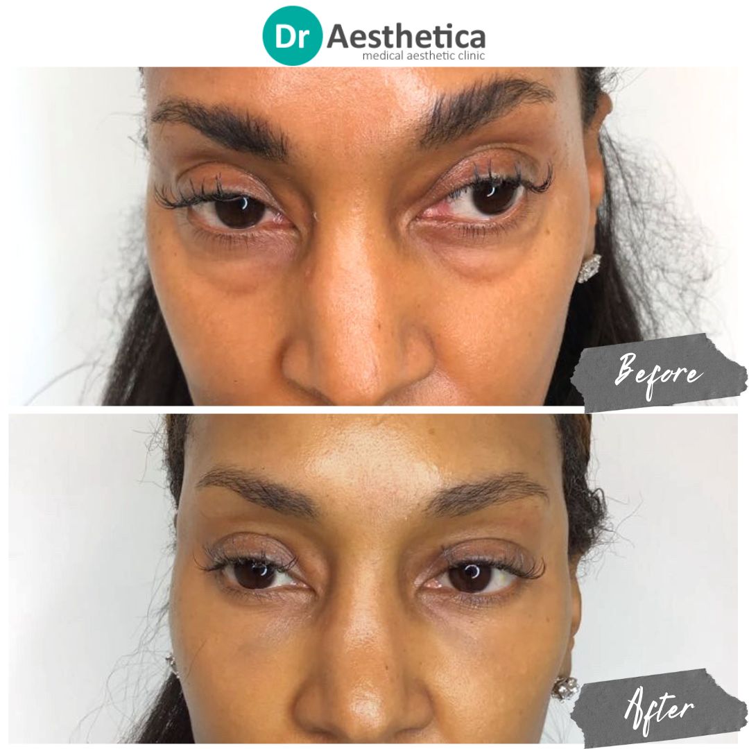 Dark under eyes making you look tired, tear trough filler at Dr Aesthetica to correct under eye bags