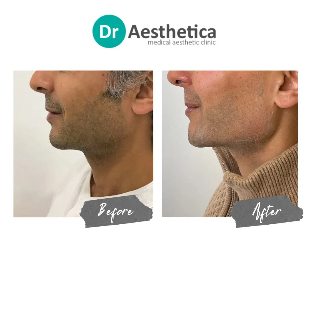 Defined Jawline Male Dermal Filler Chin and Jaw
