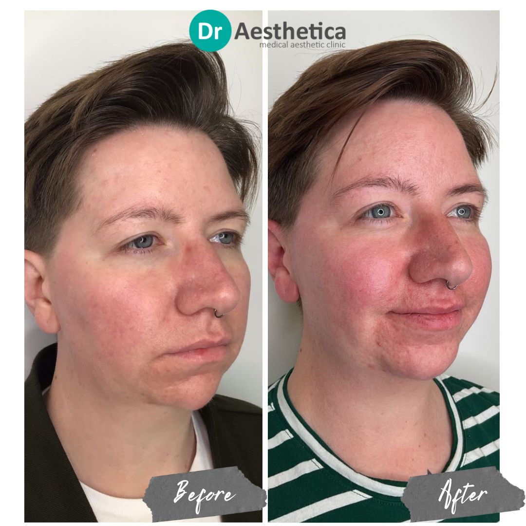 Face rebalance chin filler