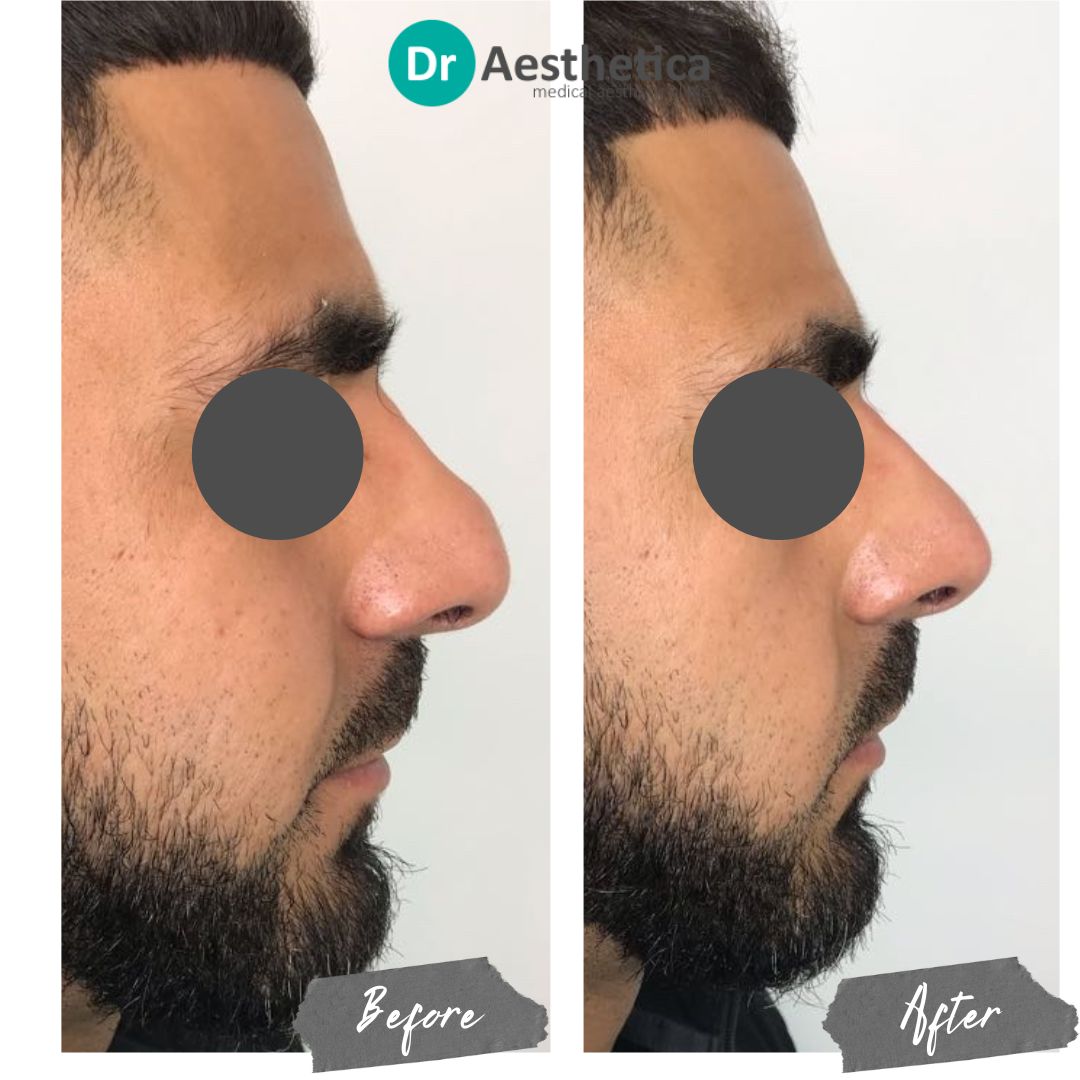 Hooked nose improvements with dermal filler in birmingham