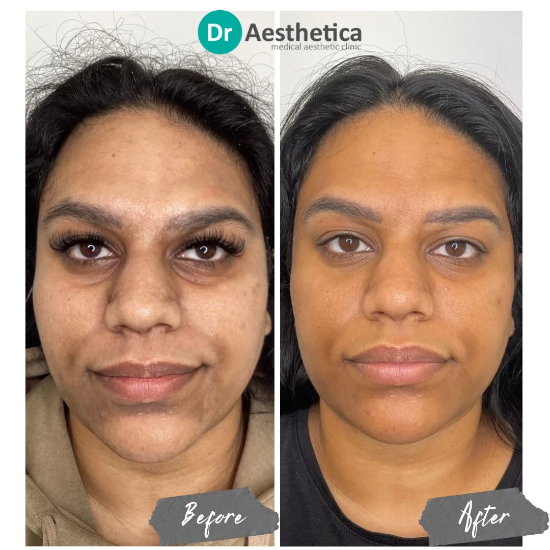 A New Approach To The Non-Surgical Facelift