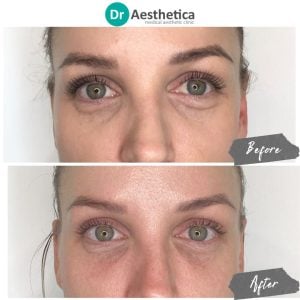 Reduce under eye groove to make eyes more awake with tear trough filler birmingham