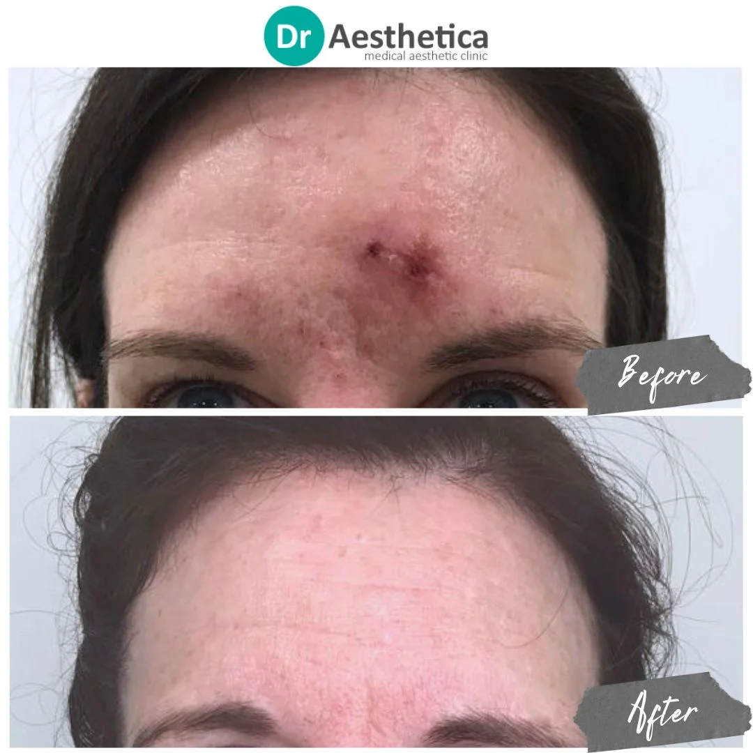 aggressive dry skin microneedling
