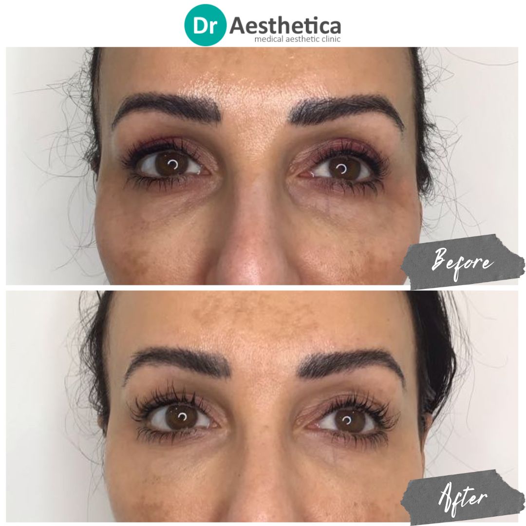 A woman who visited our west midlands clinic and received dark under eye treatment