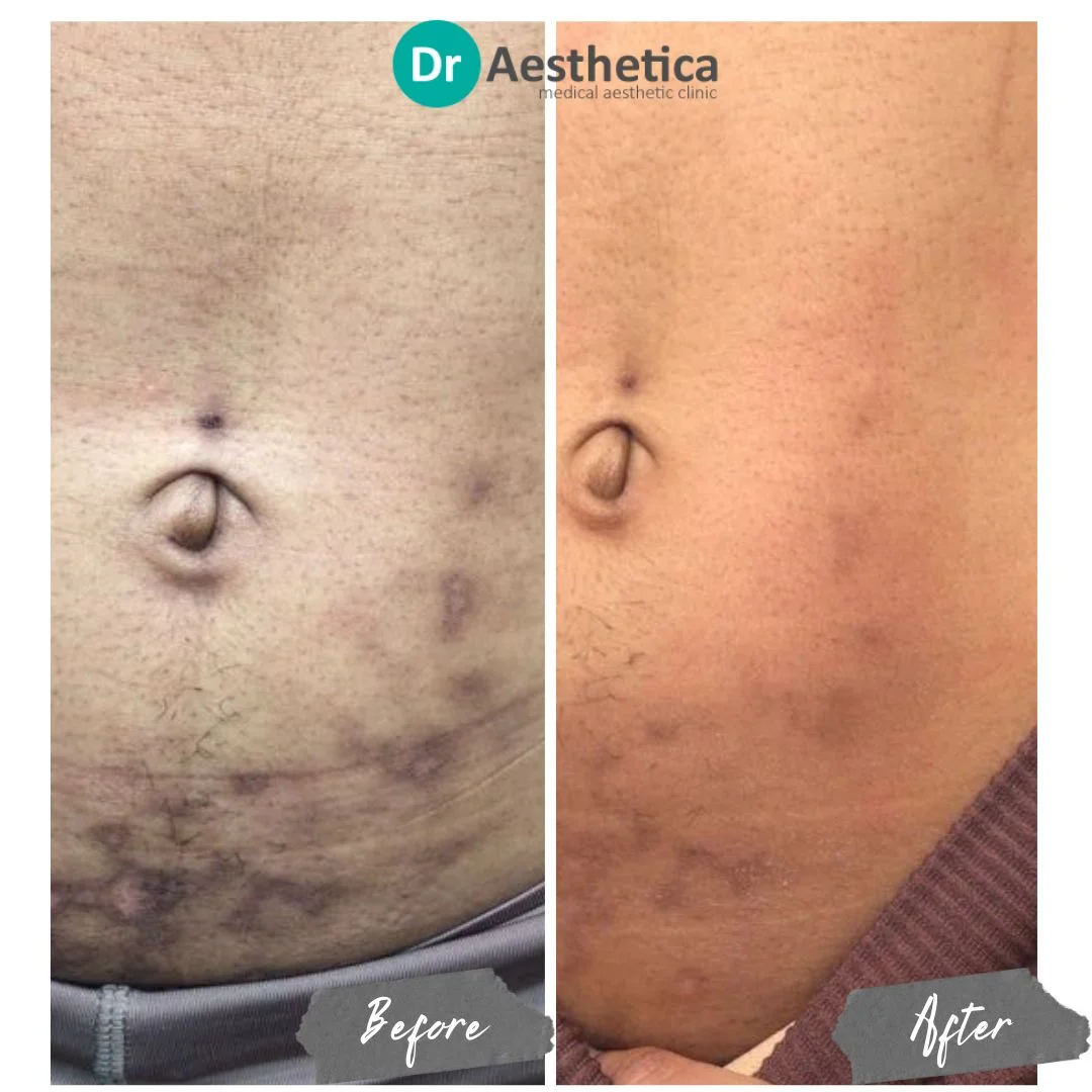 belly scar microneedling