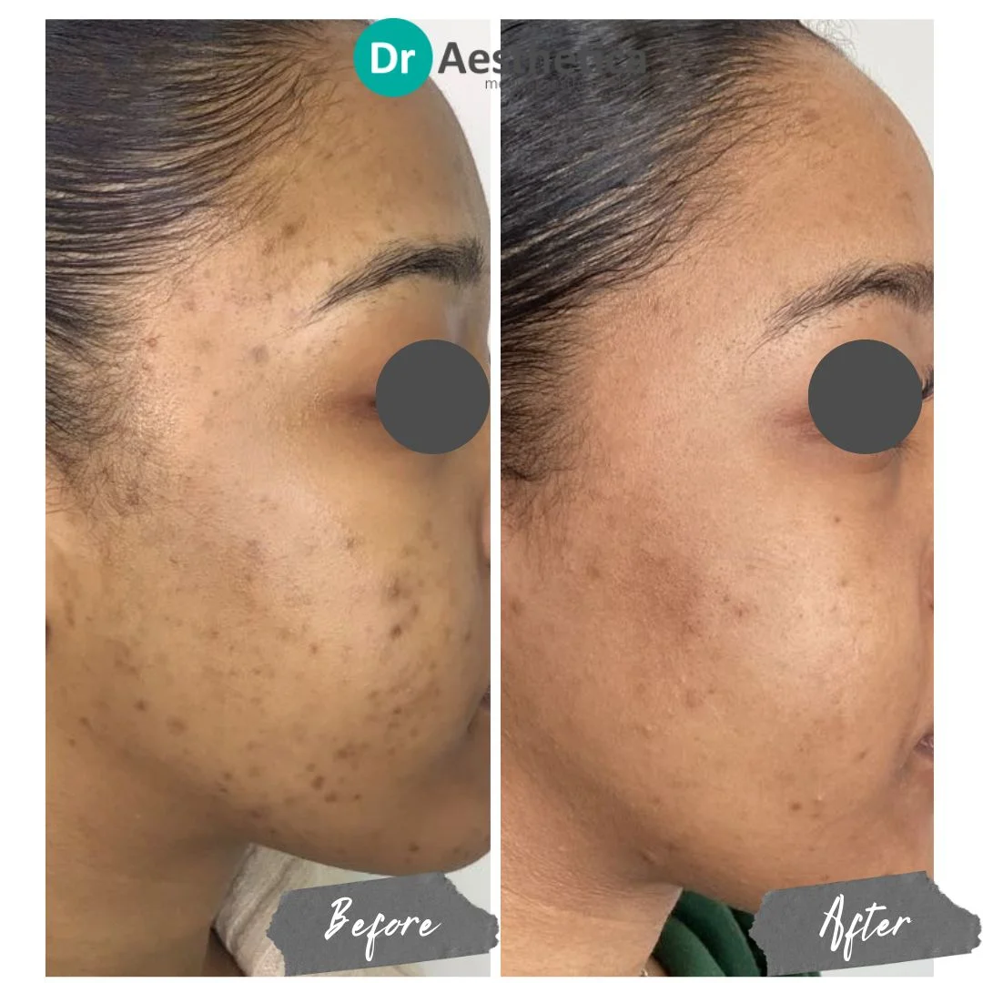 cheek acne Microneedling dark skin
