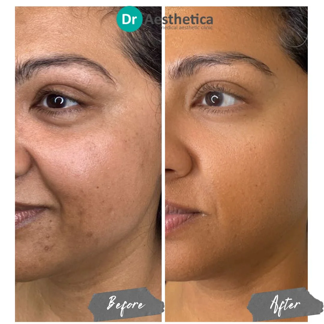 Side-by-side comparison of a woman’s face before and after Stem Cell Microneedling treatment. The ‘before’ image shows uneven skin texture, fine lines, and dullness, while the ‘after’ image reveals smoother, firmer skin with a brighter, more radiant complexion, highlighting the rejuvenating effects of the treatment