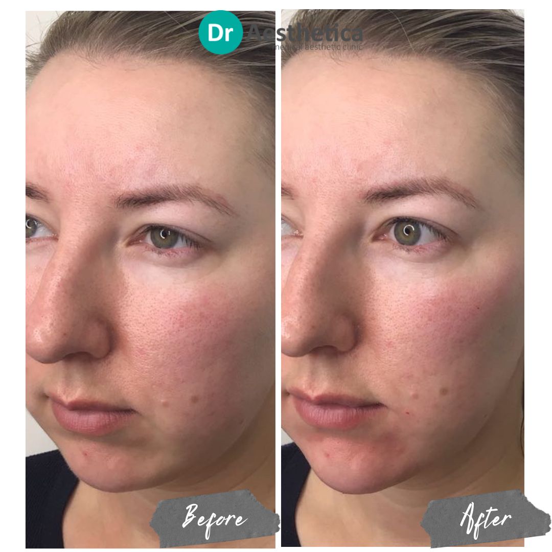 enhanced chin with dermal filler