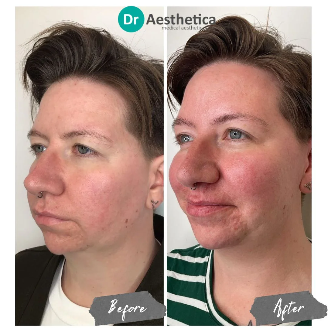 feminise jawline with chin and jaw filler