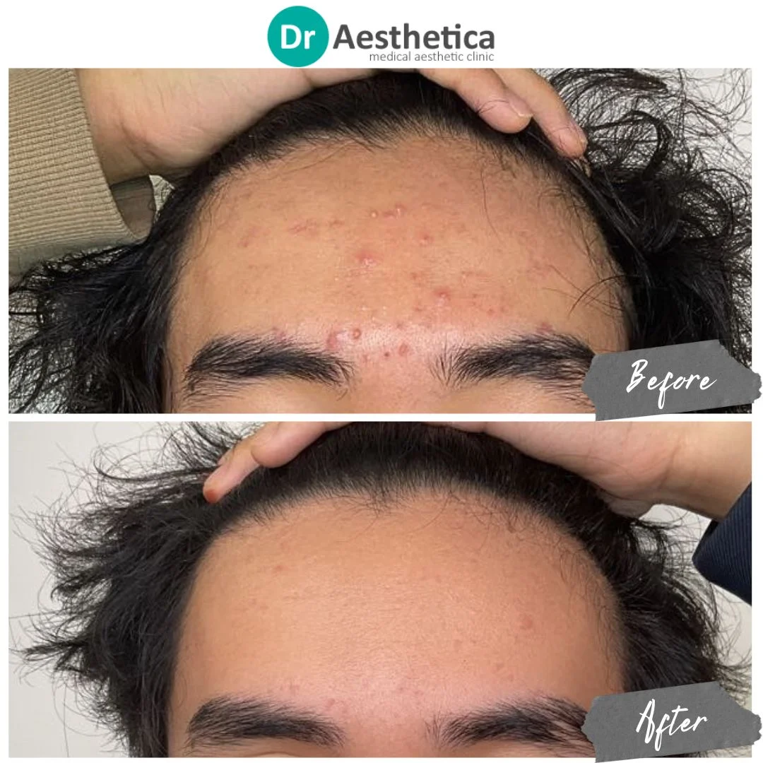 forehead acne - male improved with microneedling