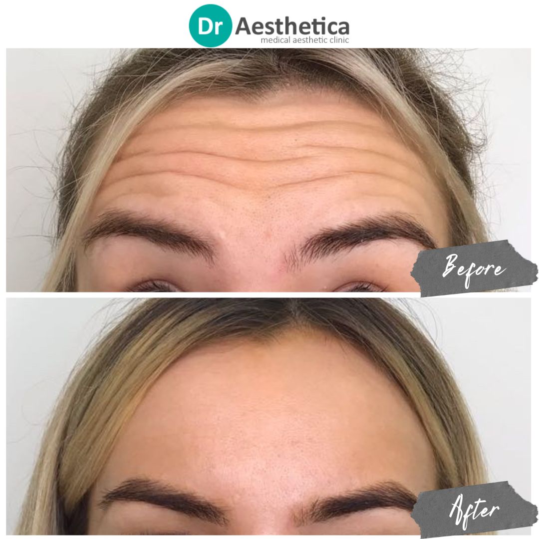 Side-by-side comparison of a woman’s forehead before and after Botox treatment. The ‘before’ image shows noticeable horizontal lines and wrinkles, while the ‘after’ image displays a smoother, wrinkle-free forehead, highlighting the effectiveness of Botox in reducing the appearance of fine lines.