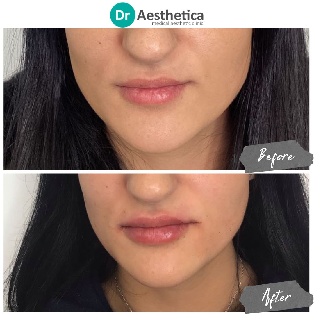 Subtle lip enhancement with dermal fillers—before and after photos from Dr. Aesthetica Birmingham.