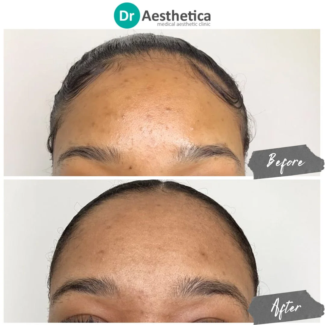 microneedling - acne head