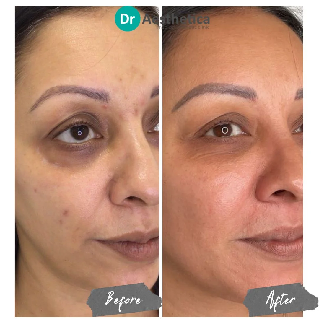 microneedling refresh