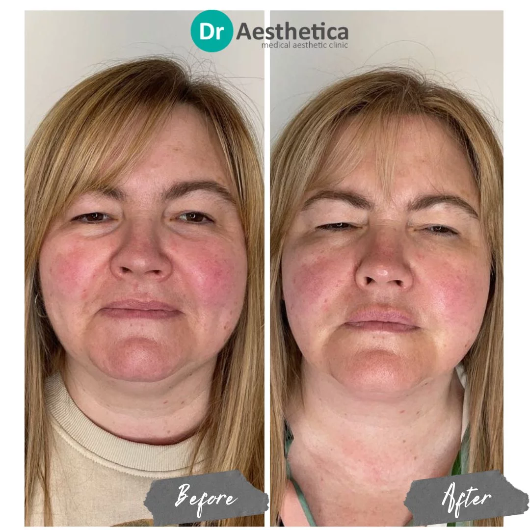 Face and neck skin tightening lift jowls no pain no downtime
