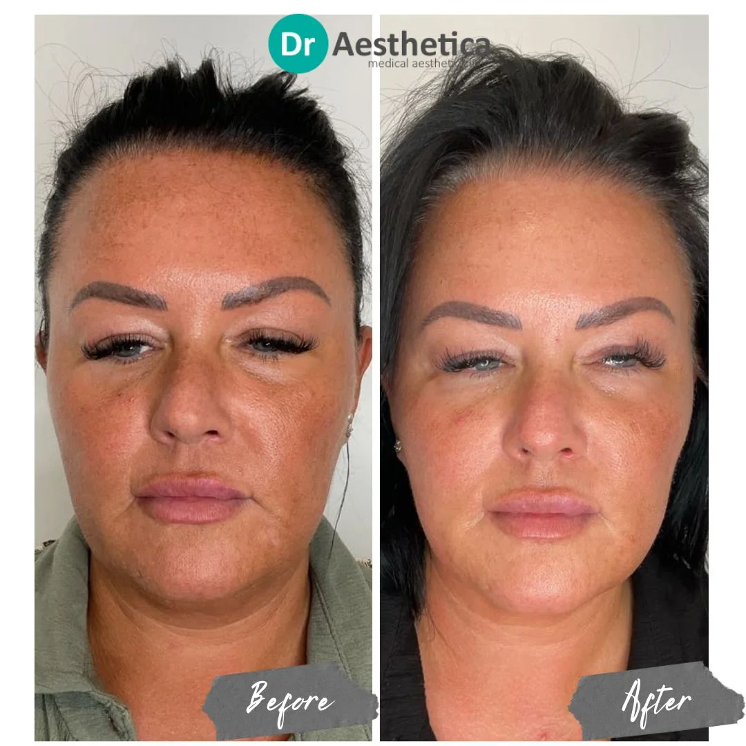Face and neck tightening cheek lift skin tightening no downtime no pain