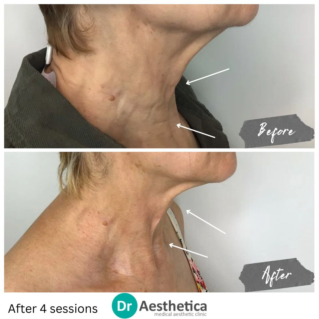 Improve neck Skin quality with Neck Radiofrequency