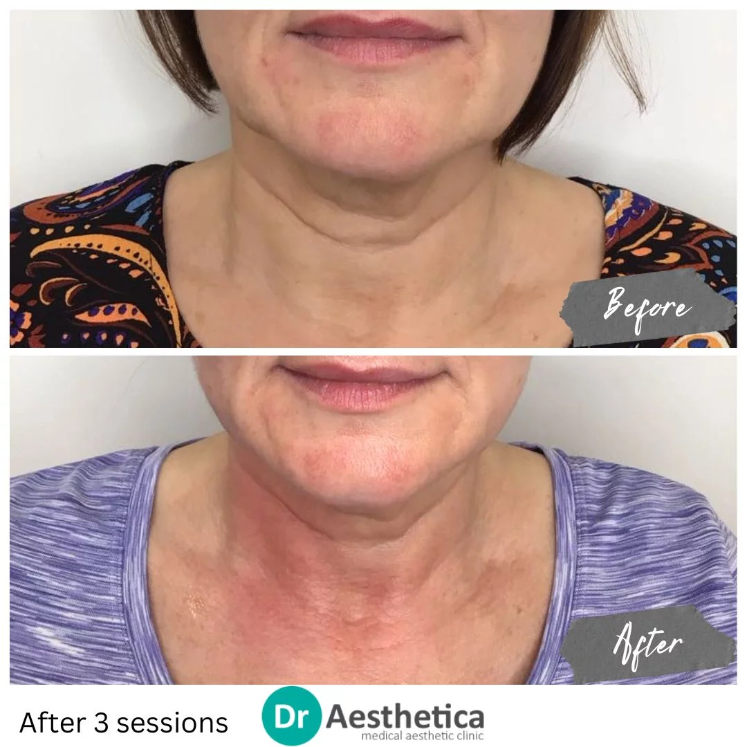 Neck band improved with Skin Tightening Radiofrequency no pain no downtime
