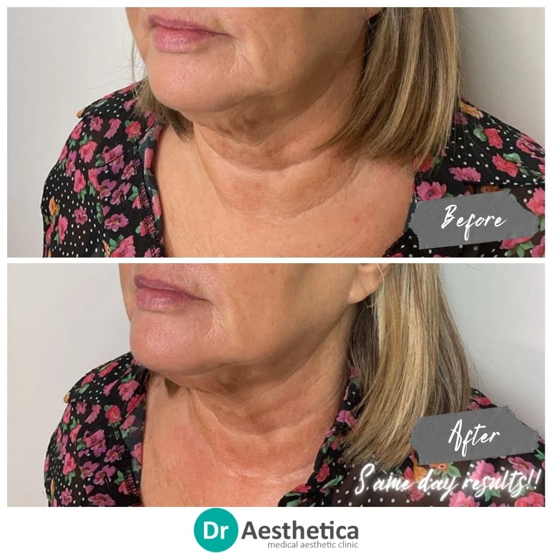 Same day results neck Tightening with Radiofrequency No Pain