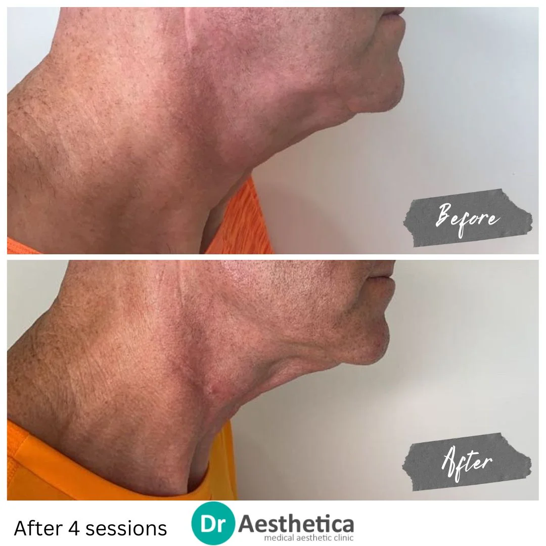 Define Neck from face, improve jawline with Skin Tightening Radiofrequency