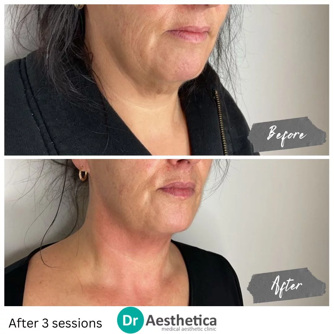 Remove Double chin with no needles, no pain, no downtime using Skin tightening Radiofrequency