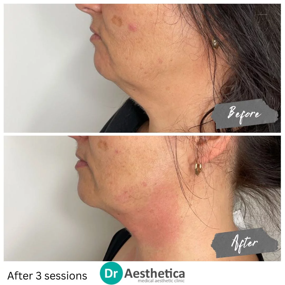 Remove Double chin with no needles, no pain, no downtime using Skin tightening Radiofrequency
