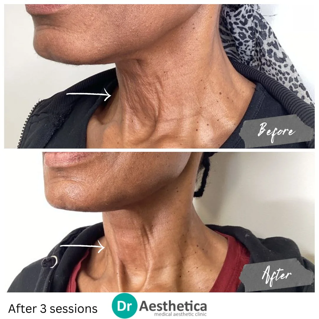 Loose Crepey Skin Improved on Neck with Skin tightening Radiofrequency
