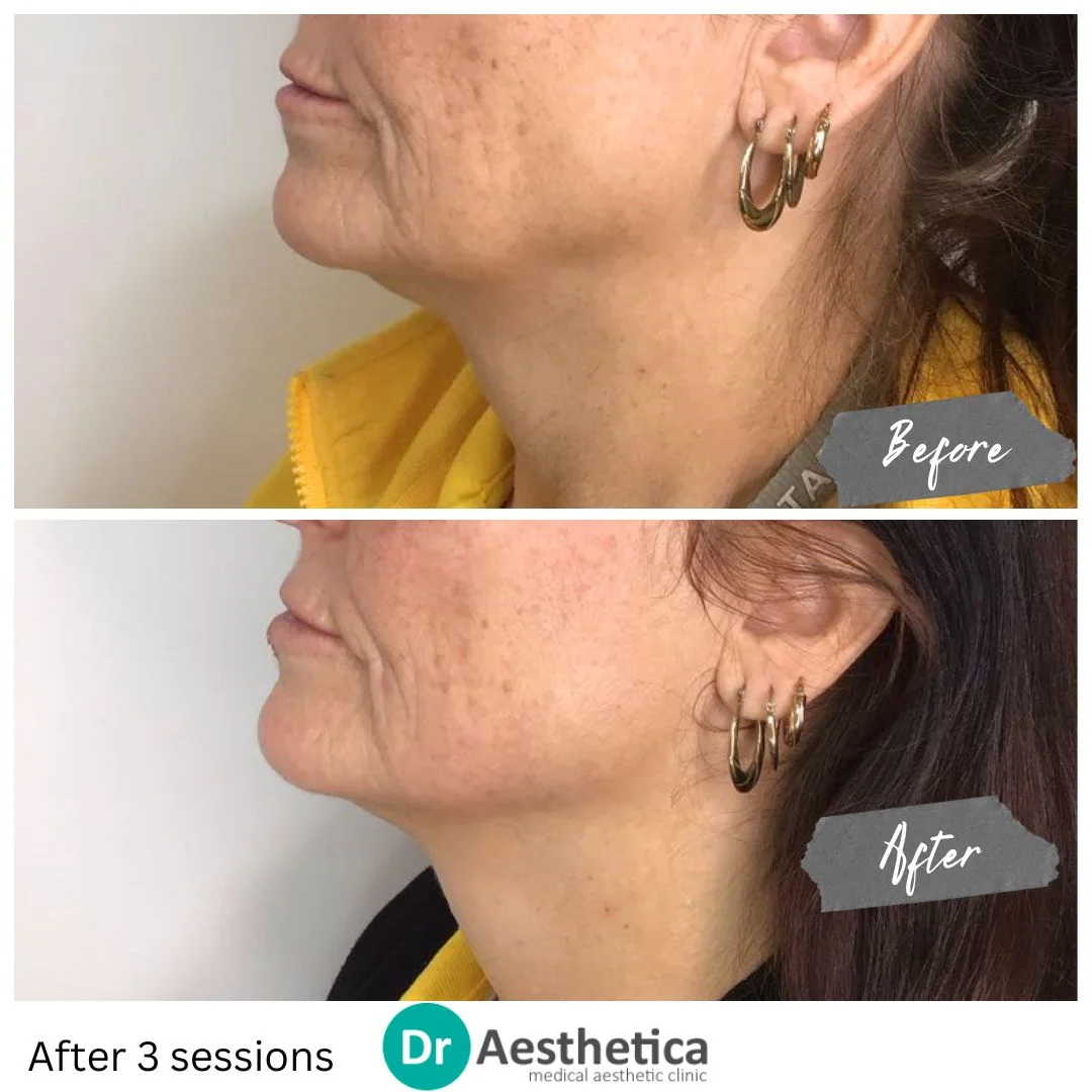 Jowls Removed, Double Chin improved with Skin Tightening