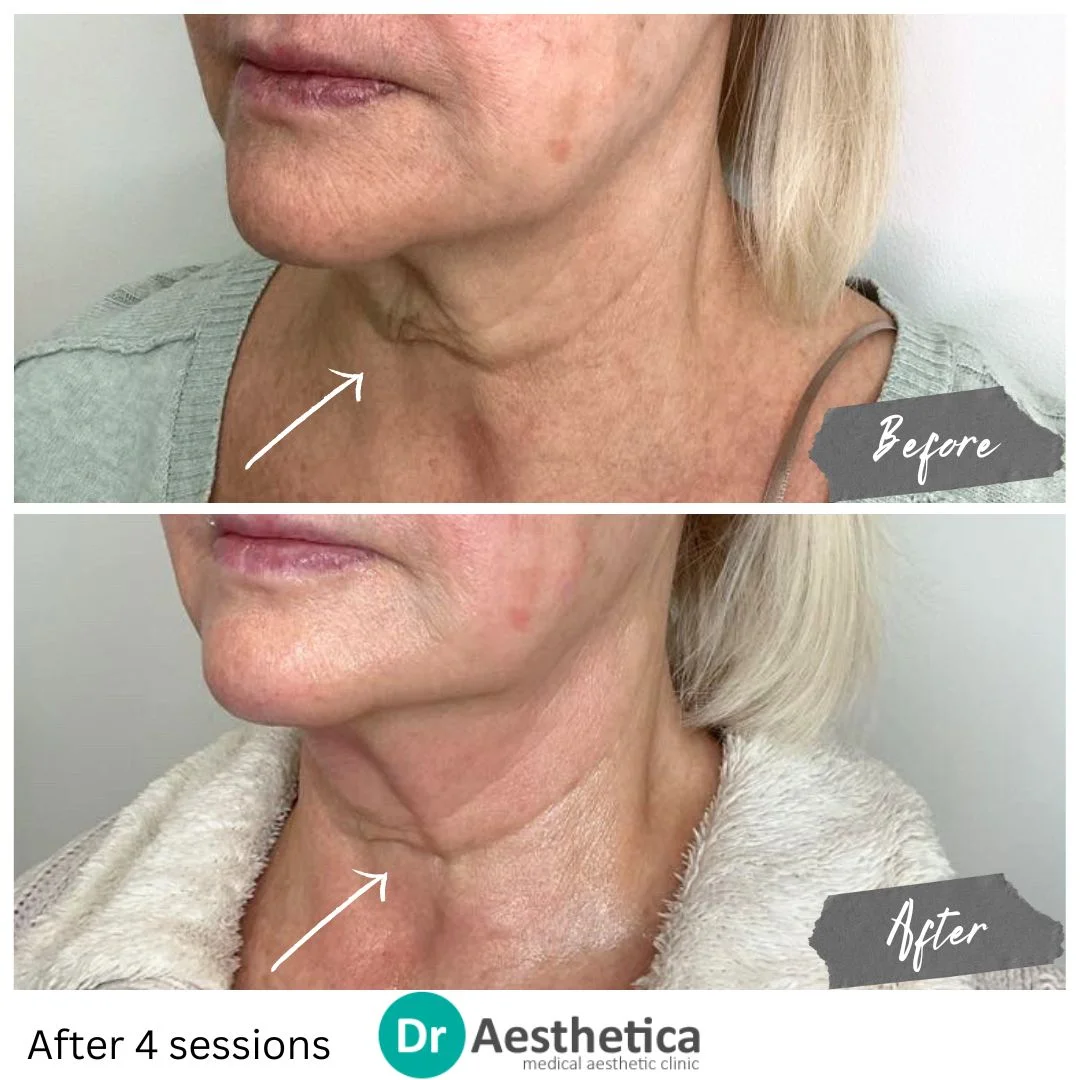 Loose Skin on Neck tightening using No Downtime No Pain Radiofrequency