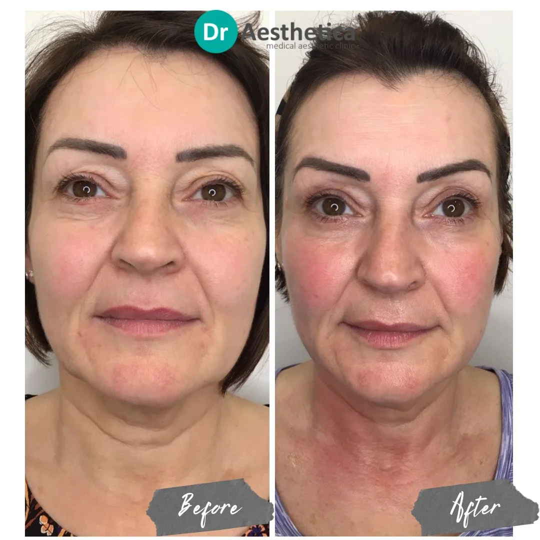 skin tightening Face and Neck Painless No downtime immediate results